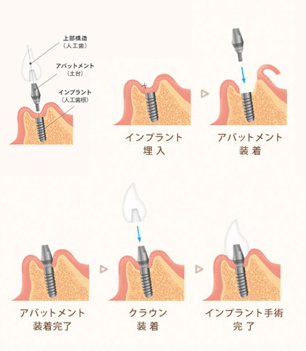 インプラント画像