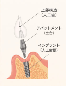 インプラント画像